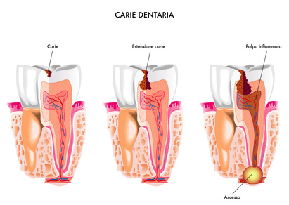 Conservativa Endodonzia: Carie dentaria
