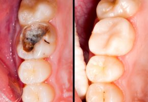 Conservativa Endodonzia:: Prima e dopo la cura endodonzica