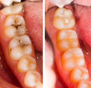 Conservativa endodonzia: prima e dopo il trattamento dentale