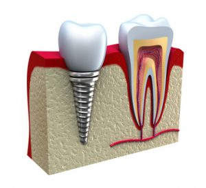 Implantologia: Anatomia di un dente sano e impianto dentale in osso della mascella.