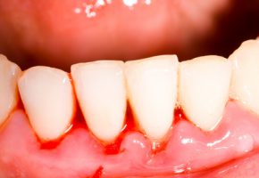 Parodontologia: sanguinamento dei denti