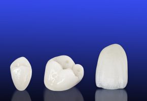 Protesi fissa: esempi di corone dentali in ceramica prive di metallo