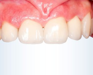 Estetica del sorriso: dopo il trattamento