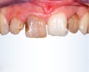 Estetica del sorriso: prima del trattamento