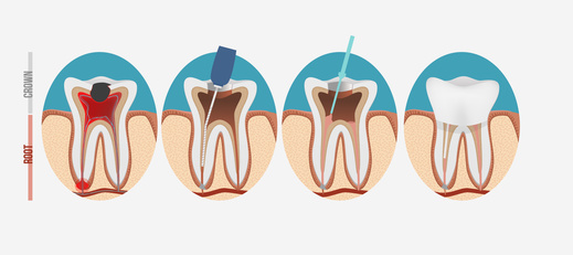 Conservativa Endodonzia: Cura canalare con eliminazione del tessuto endodontico malato