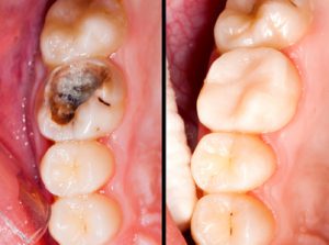 Conservativa Endodonzia:: Prima e dopo la cura endodonzica