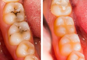 Conservativa endodonzia: prima e dopo il trattamento dentale