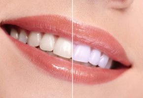 Estetica del sorriso: prima e dopo il trattamento di sbiancamento