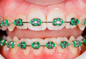 Ortodonzia: apparecchio dentale fisso