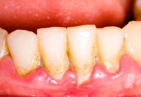 Parodontologia: tartaro dentale