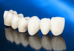 Protesi fissa: esempi di corone dentali di ceramica