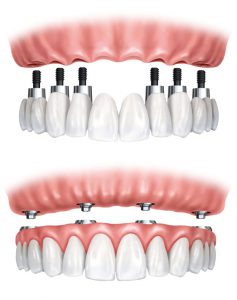 Protesi fissa: esempi di protesi dentali