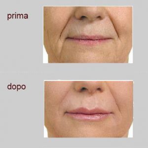 Filler naso geniene prima e dopo