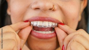 Applicazione Invisalign