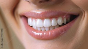 Faccette Dentali Sorriso