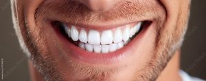 Faccette Estetiche