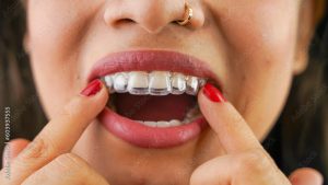 Trattamento Invisalign